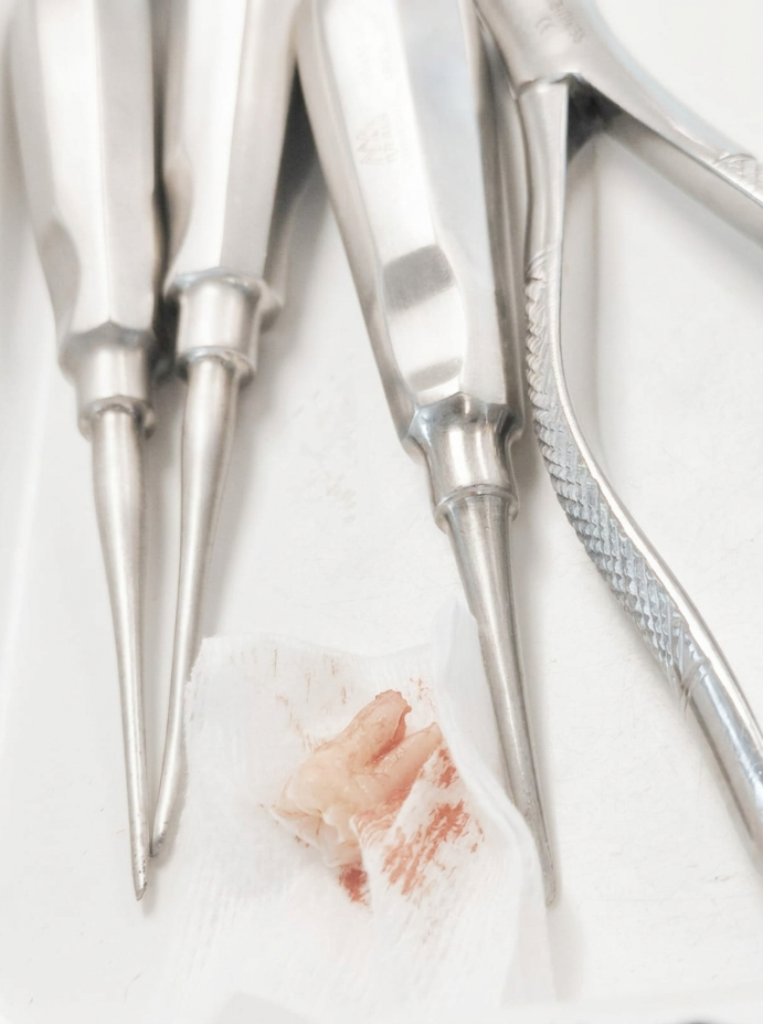 Simple Tooth Extraction